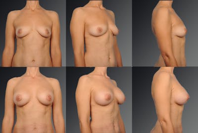 Breast Augmentation Before & After Gallery - Patient 104098378 - Image 1