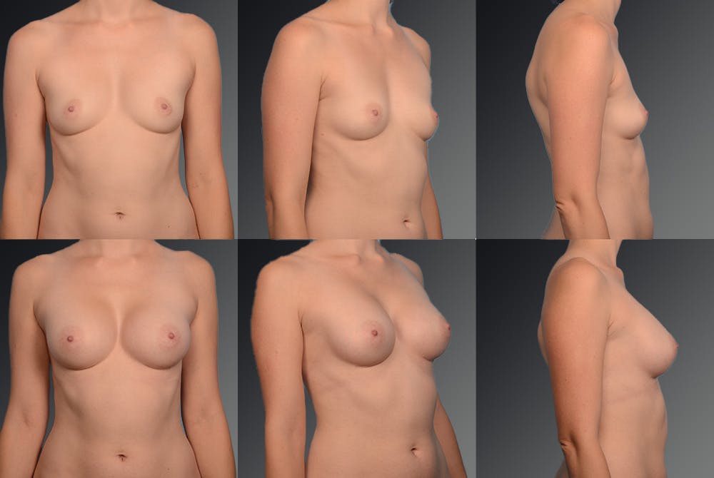 Breast Augmentation Before & After Gallery - Patient 104098379 - Image 1