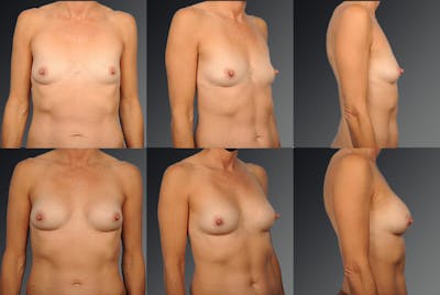 Breast Augmentation Before & After Gallery - Patient 104098380 - Image 1