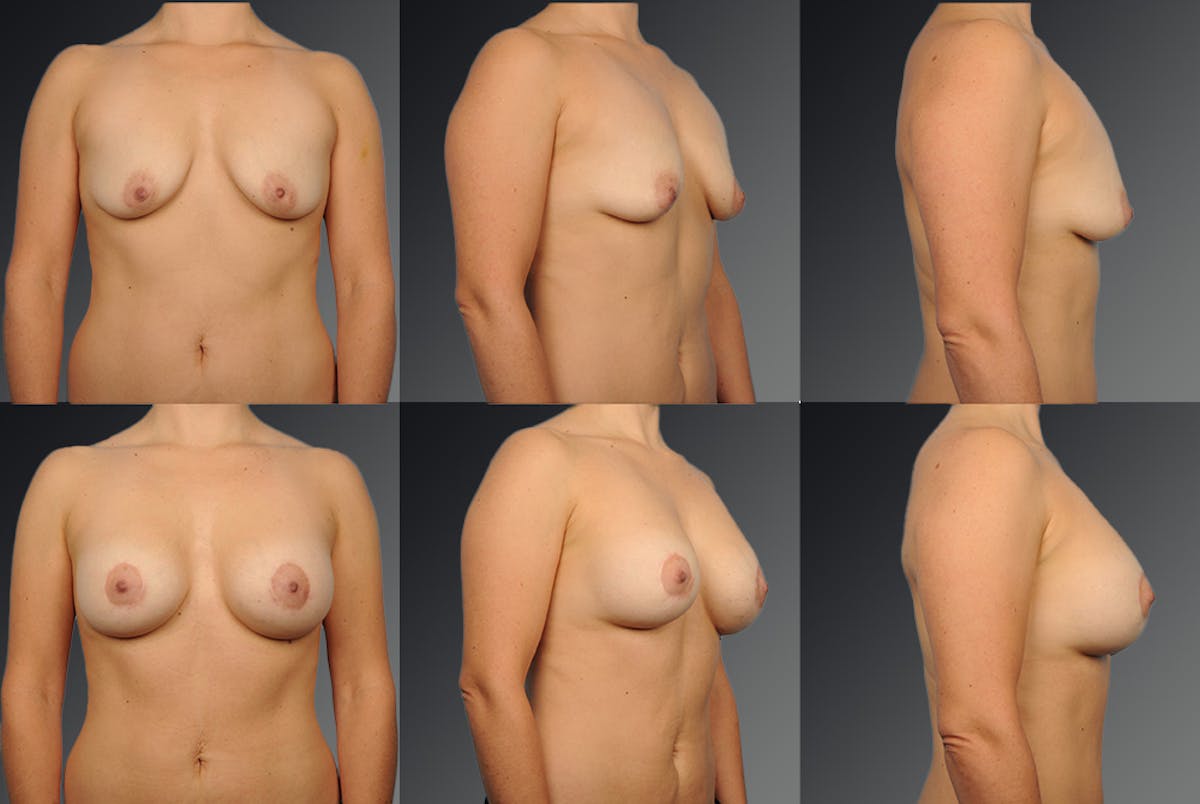 Breast Augmentation Before & After Gallery - Patient 104098381 - Image 1