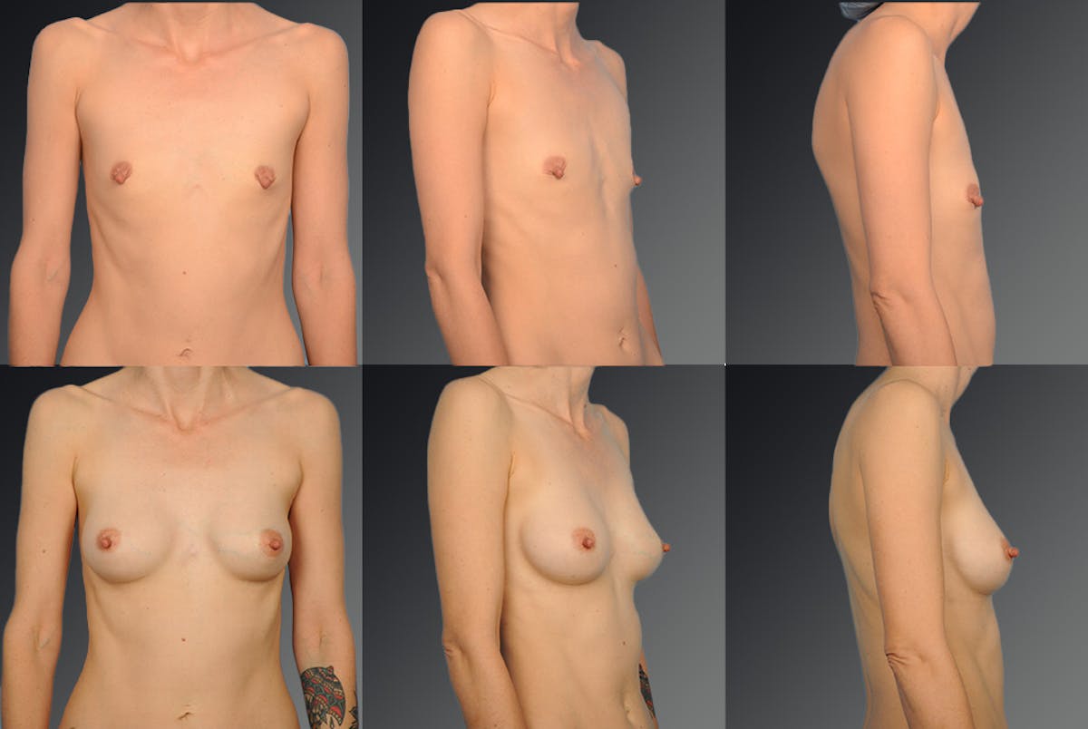 Breast Augmentation Before & After Gallery - Patient 104098382 - Image 1