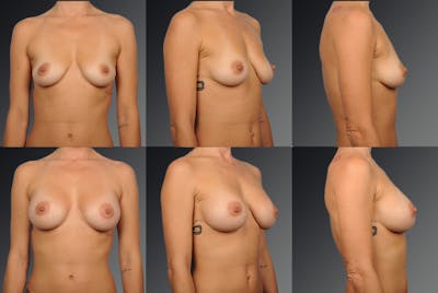 Breast Augmentation Before & After Gallery - Patient 104098383 - Image 1