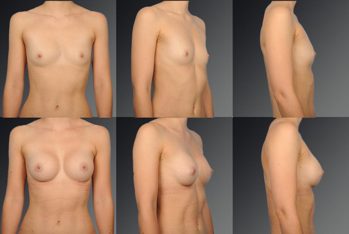 Breast Augmentation Before & After Gallery - Patient 104098388 - Image 1