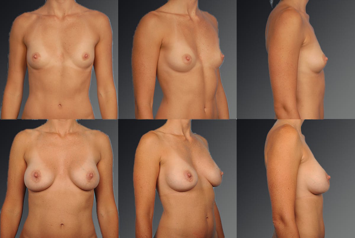 Breast Augmentation Before & After Gallery - Patient 104099716 - Image 1