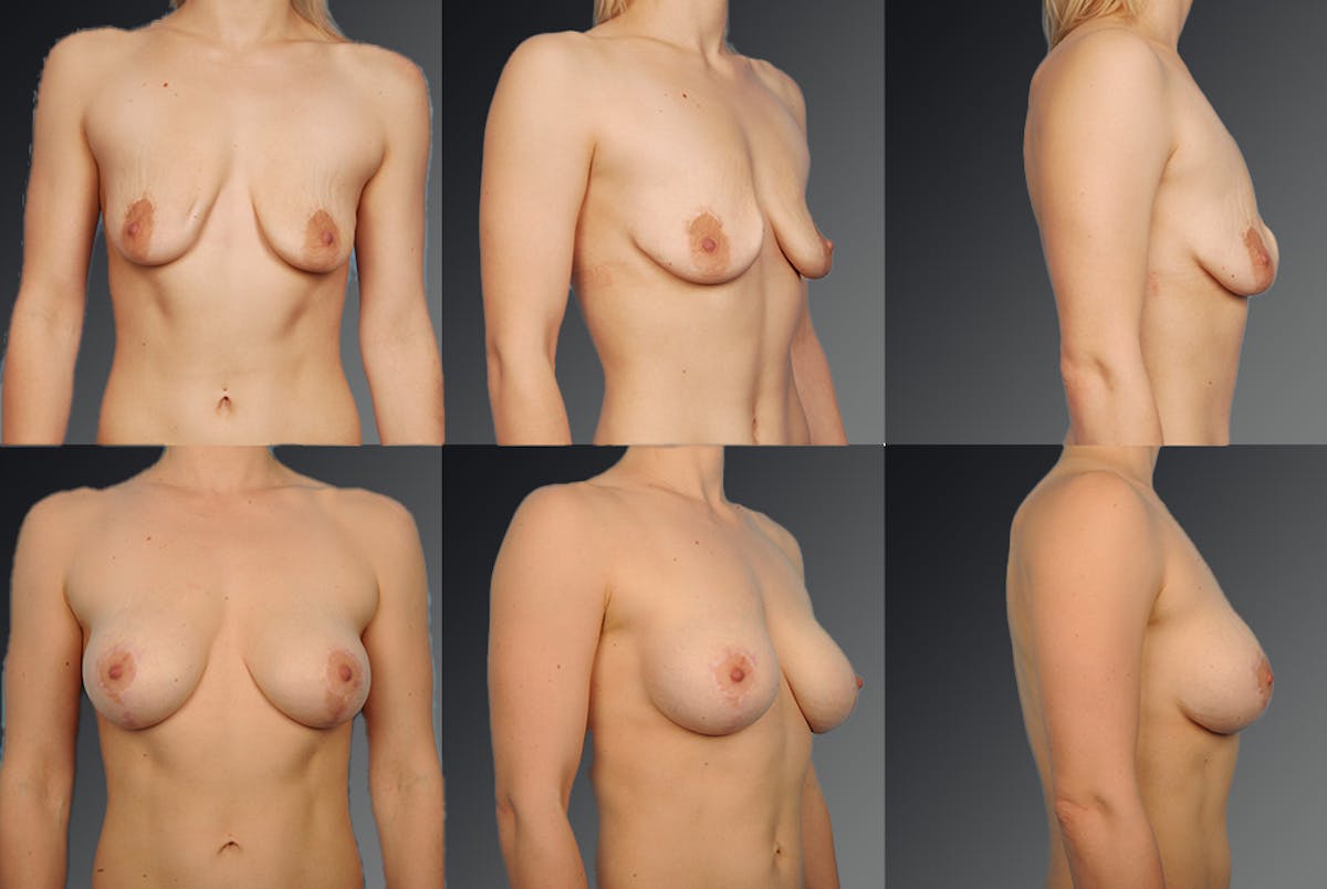 Breast Augmentation Before & After Gallery - Patient 104099718 - Image 1