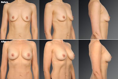 Breast Augmentation Before & After Gallery - Patient 104099719 - Image 1