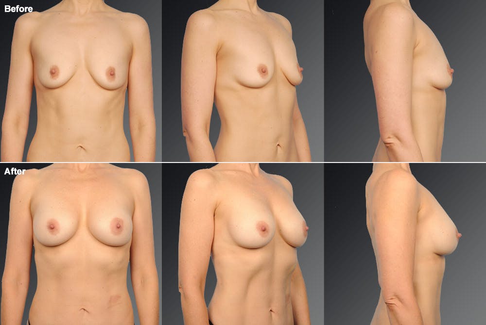 Breast Augmentation Before & After Gallery - Patient 104099719 - Image 1