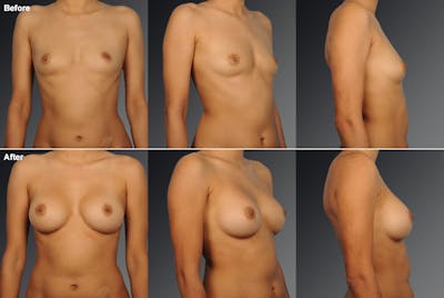 Breast Augmentation Before & After Gallery - Patient 104099733 - Image 1