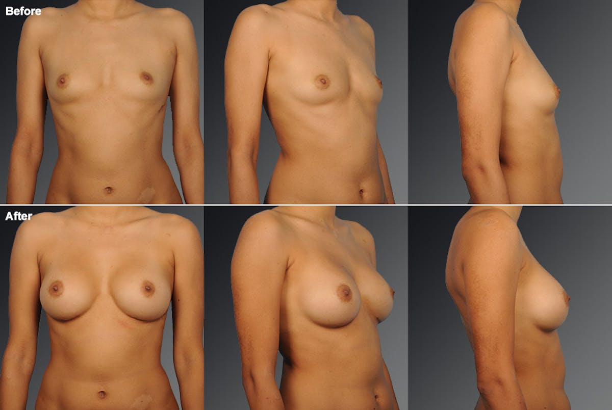 Breast Augmentation Before & After Gallery - Patient 104099733 - Image 1