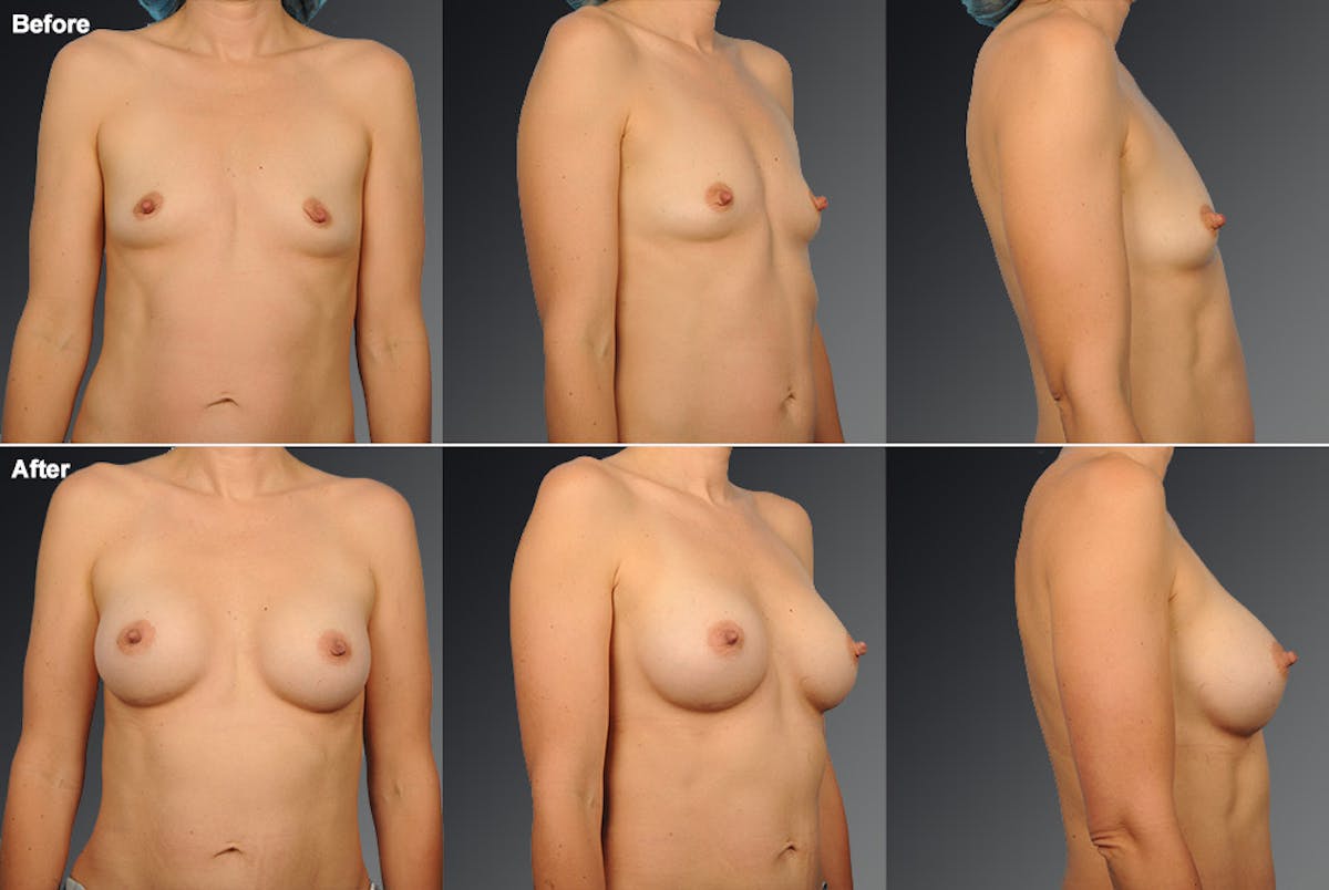 Breast Augmentation Before & After Gallery - Patient 104099734 - Image 1