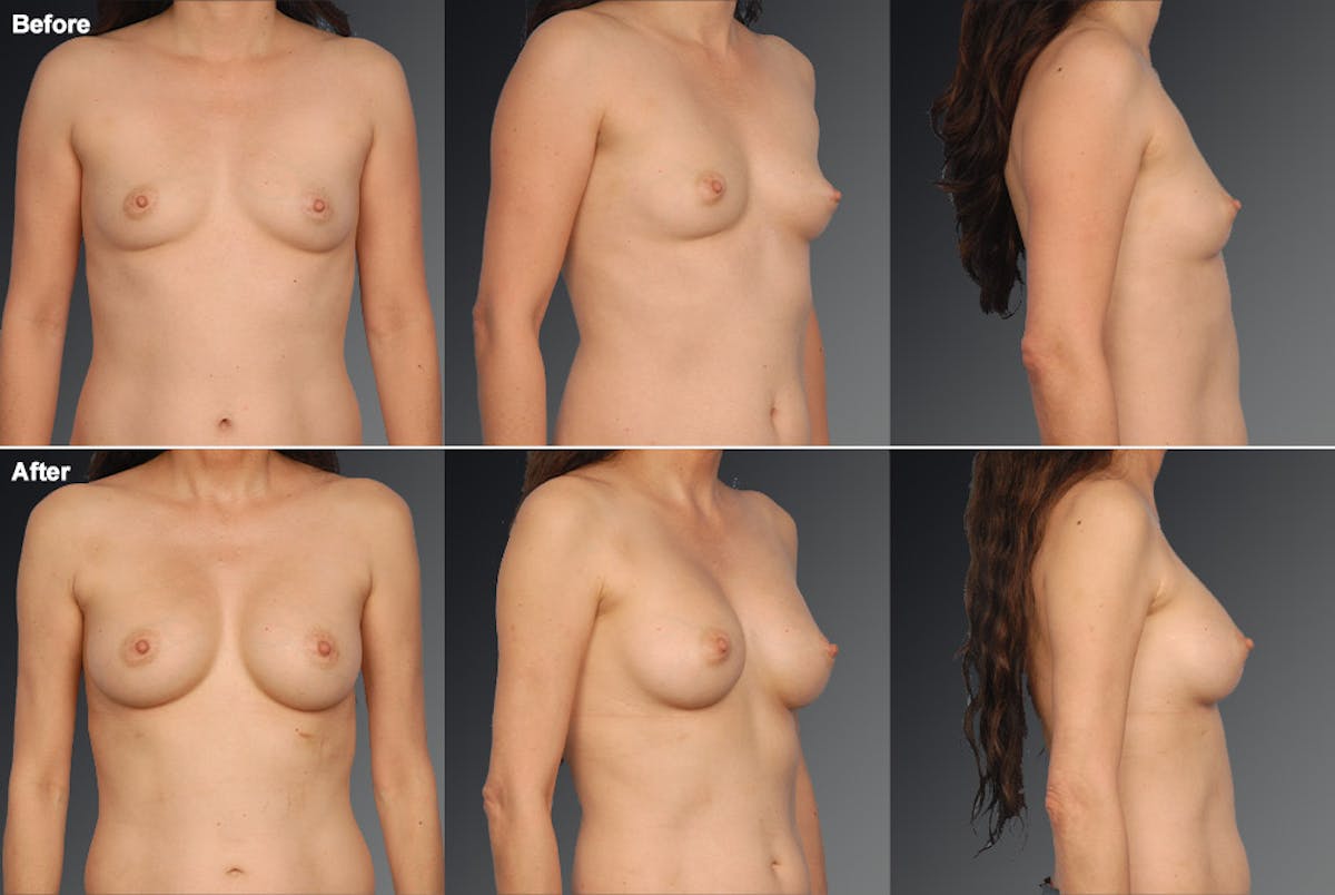 Breast Augmentation Before & After Gallery - Patient 104099736 - Image 1