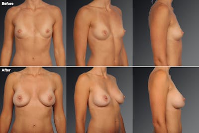 Breast Augmentation Before & After Gallery - Patient 104099739 - Image 1