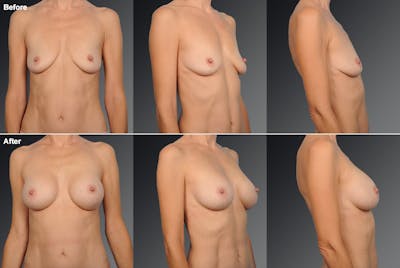 Breast Augmentation Before & After Gallery - Patient 104099753 - Image 1