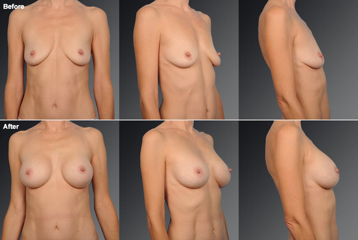 Breast Augmentation Before & After Gallery - Patient 104099753 - Image 1