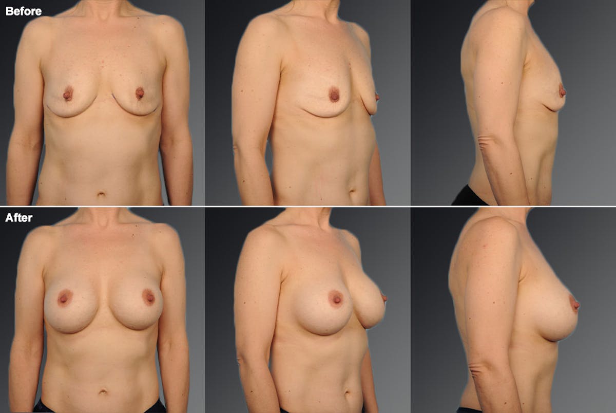 Breast Augmentation Before & After Gallery - Patient 104099754 - Image 1