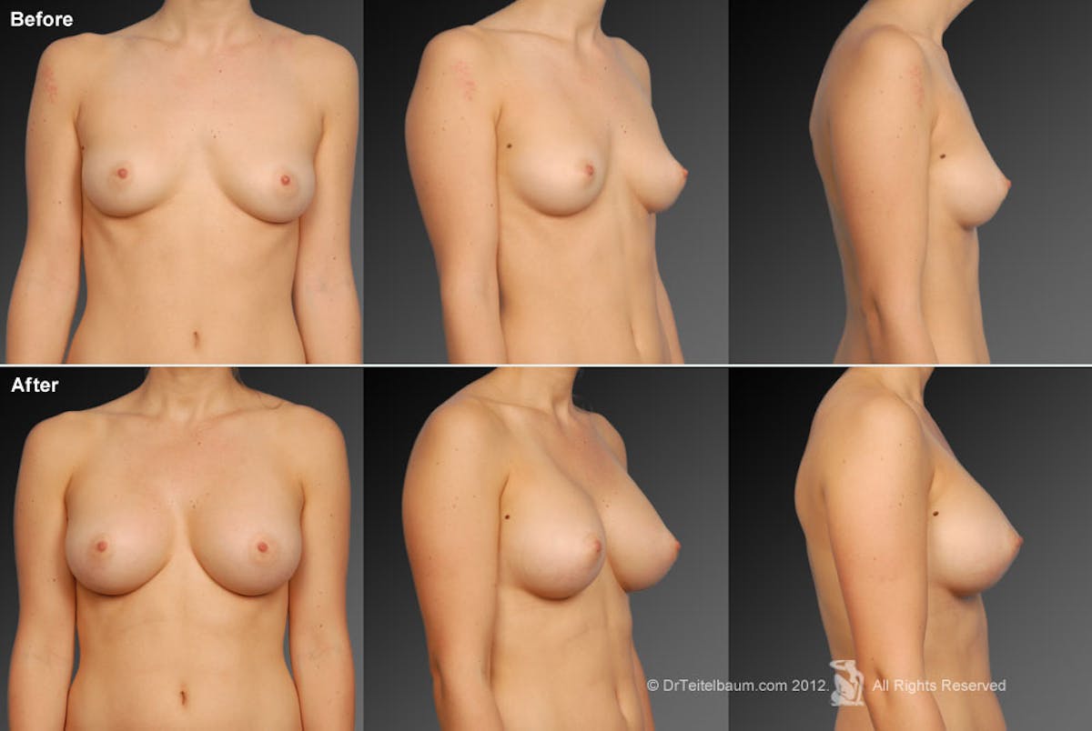 Breast Augmentation Before & After Gallery - Patient 104099786 - Image 1