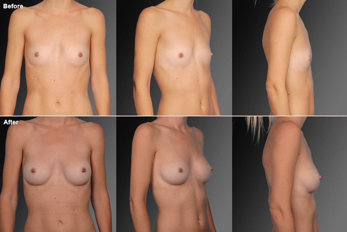 Breast Augmentation Before & After Gallery - Patient 104101124 - Image 1