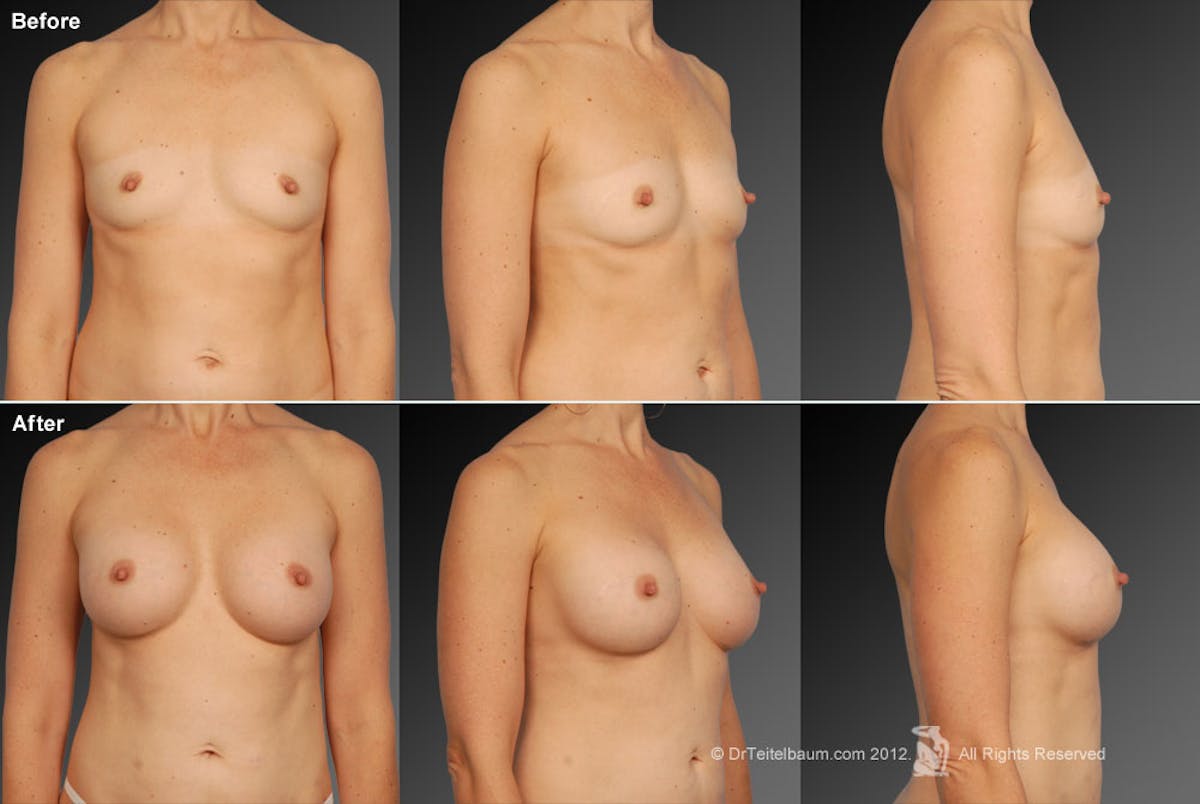 Breast Augmentation Before & After Gallery - Patient 104101128 - Image 1