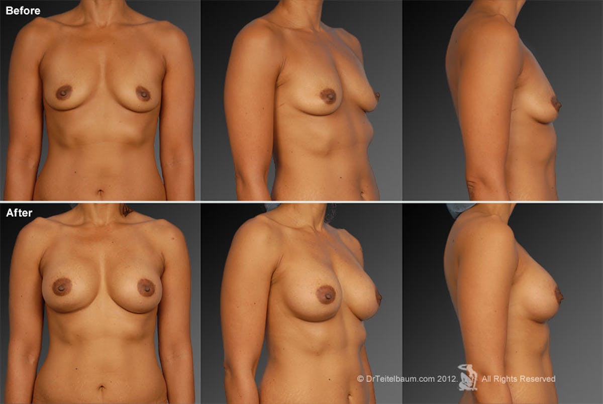Breast Augmentation Before & After Gallery - Patient 104101130 - Image 1