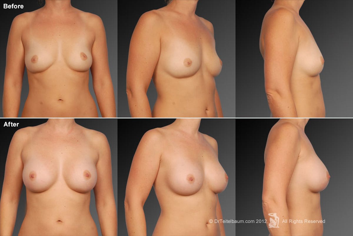Breast Augmentation Before & After Gallery - Patient 104108140 - Image 1