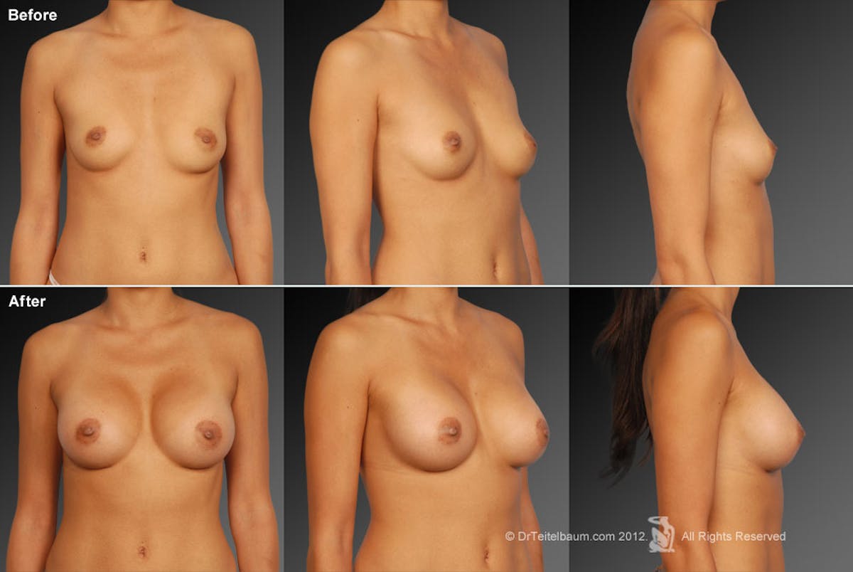 Breast Augmentation Before & After Gallery - Patient 104109131 - Image 1