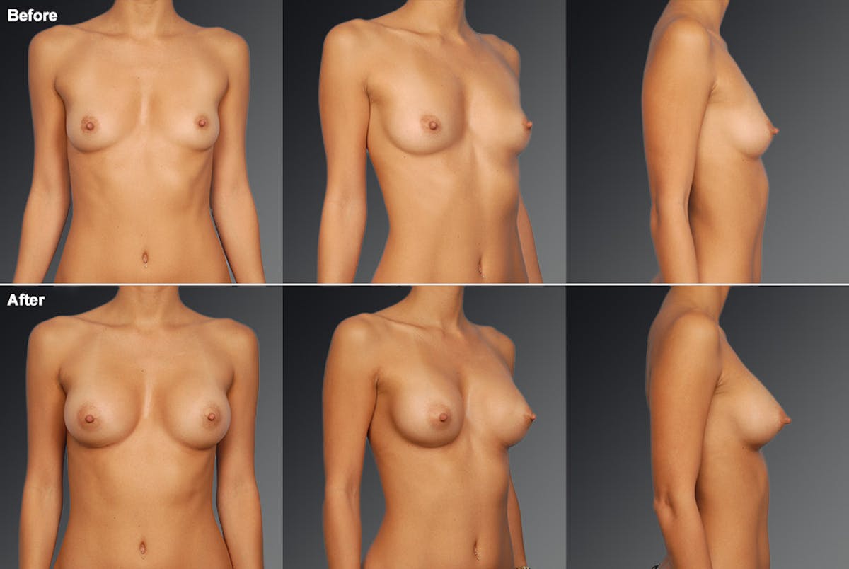 Breast Augmentation Before & After Gallery - Patient 104109134 - Image 1