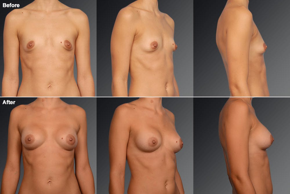 Breast Augmentation Before & After Gallery - Patient 104109135 - Image 1