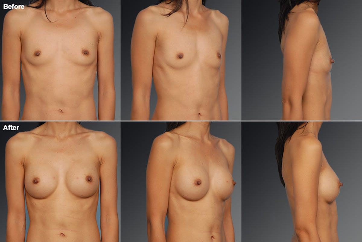 Breast Augmentation Before & After Gallery - Patient 104109138 - Image 1