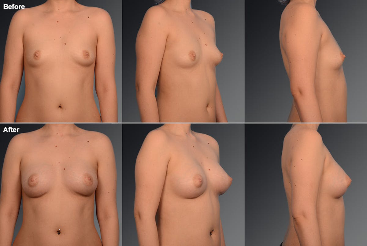 Breast Augmentation Before & After Gallery - Patient 104109141 - Image 1