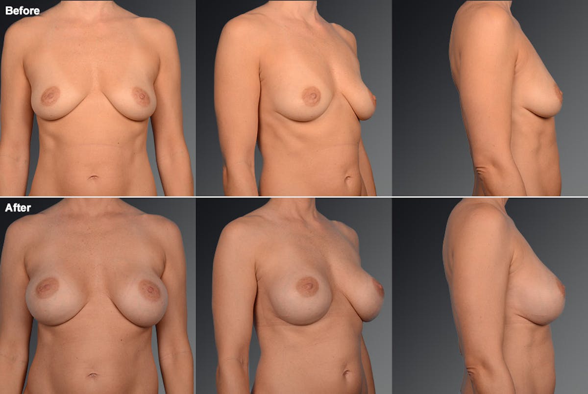 Breast Augmentation Before & After Gallery - Patient 104109145 - Image 1