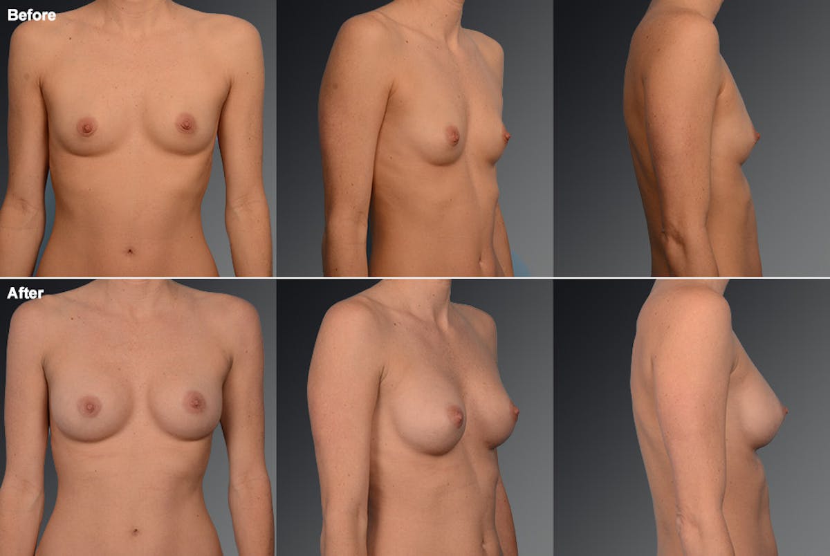 Breast Augmentation Before & After Gallery - Patient 104109147 - Image 1