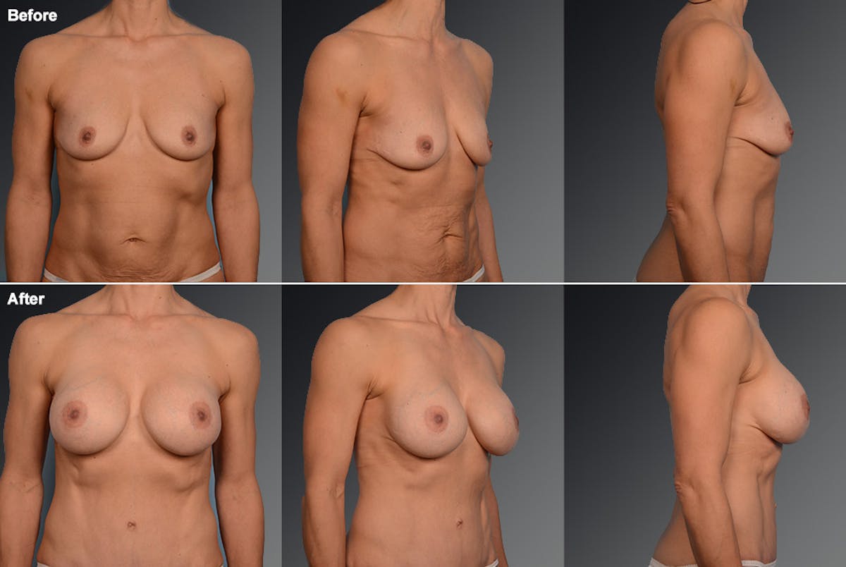 Breast Augmentation Before & After Gallery - Patient 104109148 - Image 1
