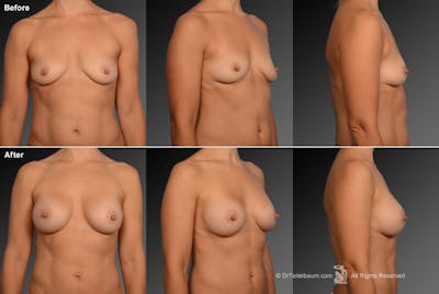 Breast Augmentation Before & After Gallery - Patient 104109150 - Image 1