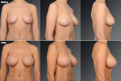 Breast Augmentation Before & After Gallery - Patient 104109151 - Image 1