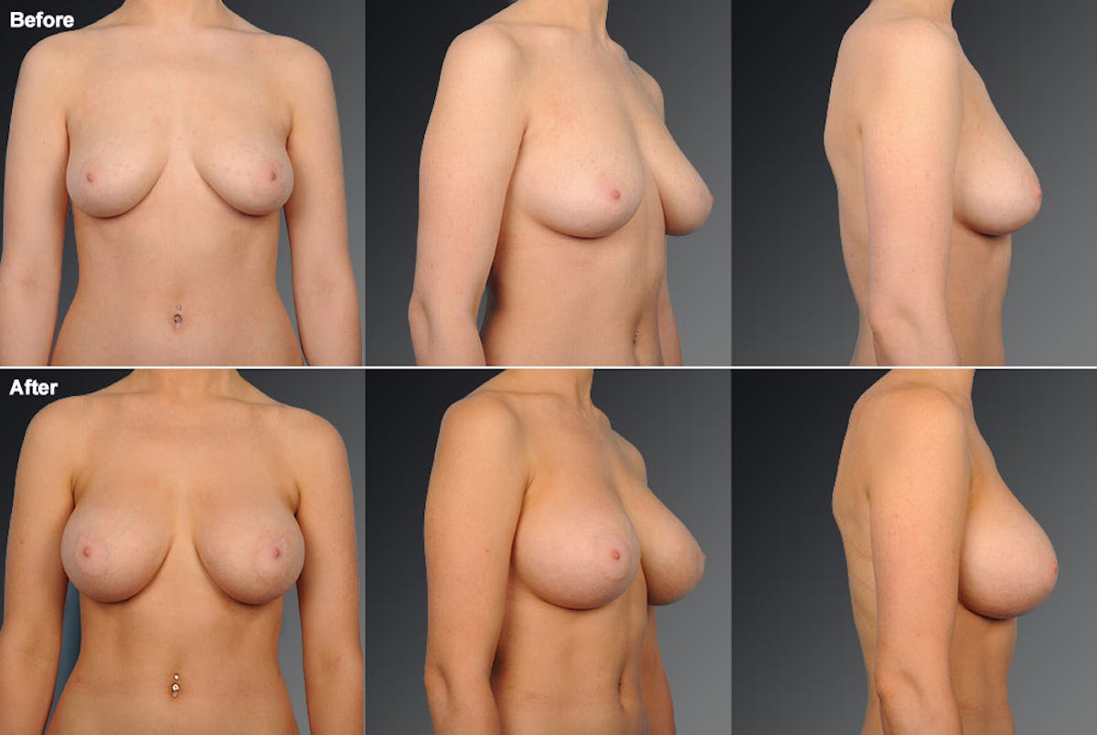 Breast Augmentation Before & After Gallery - Patient 104109151 - Image 1