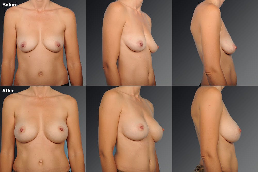 Breast Augmentation Before & After Gallery - Patient 104109153 - Image 1