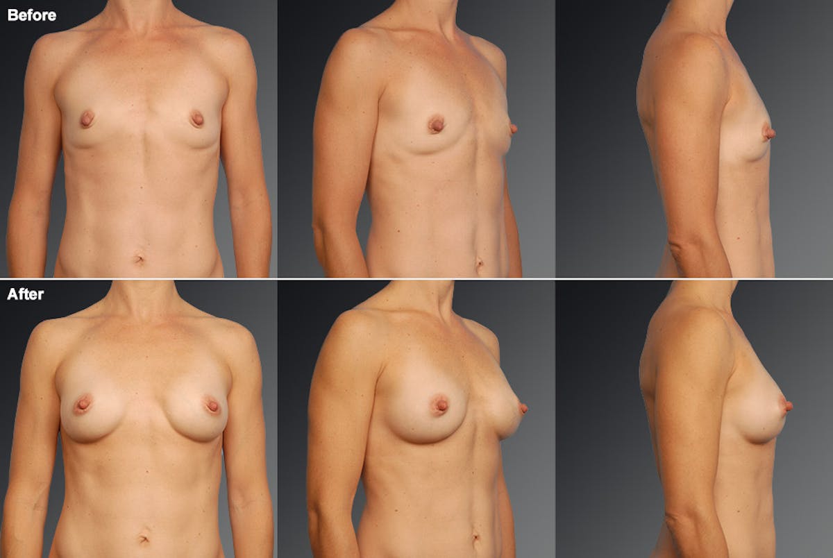 Breast Augmentation Before & After Gallery - Patient 104109156 - Image 1