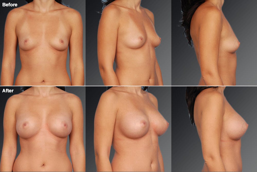 Breast Augmentation Before & After Gallery - Patient 104109161 - Image 1