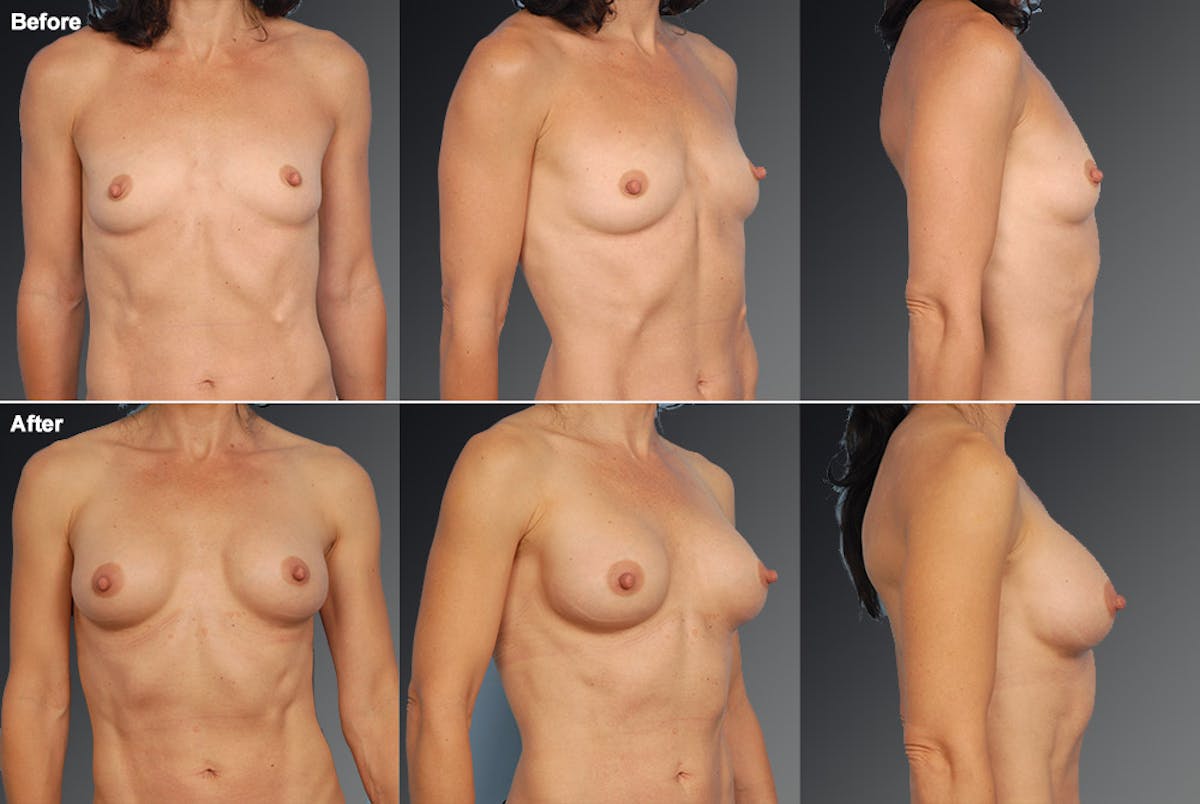 Breast Augmentation Before & After Gallery - Patient 104109163 - Image 1