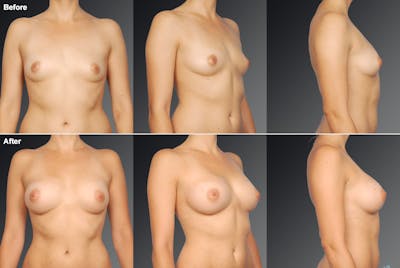 Breast Augmentation Before & After Gallery - Patient 104109164 - Image 1