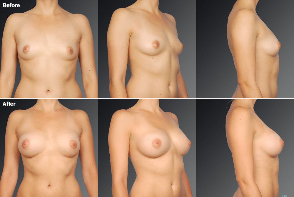 Breast Augmentation Before & After Gallery - Patient 104109164 - Image 1