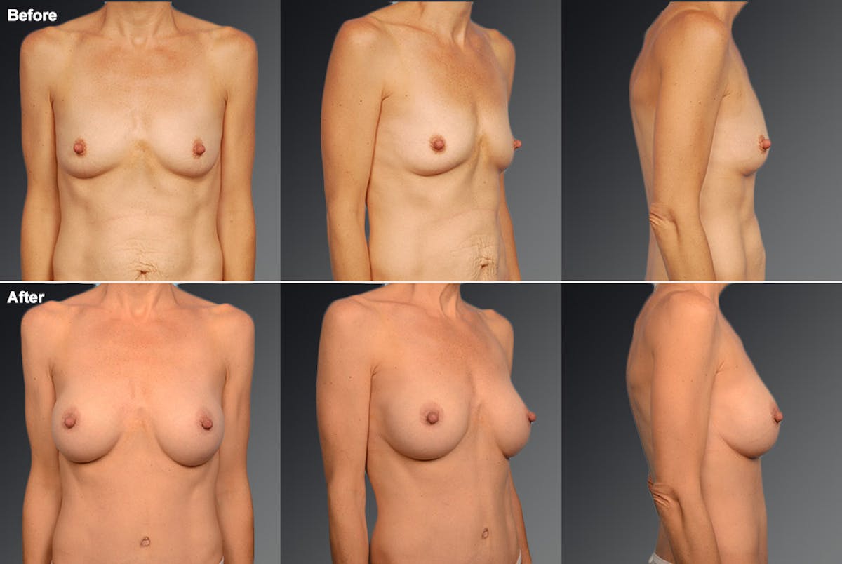 Breast Augmentation Before & After Gallery - Patient 104109171 - Image 1