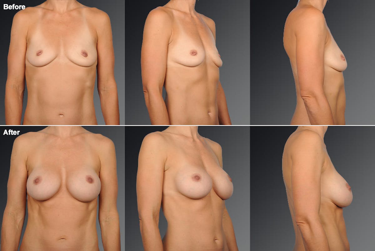 Breast Augmentation Before & After Gallery - Patient 104109172 - Image 1