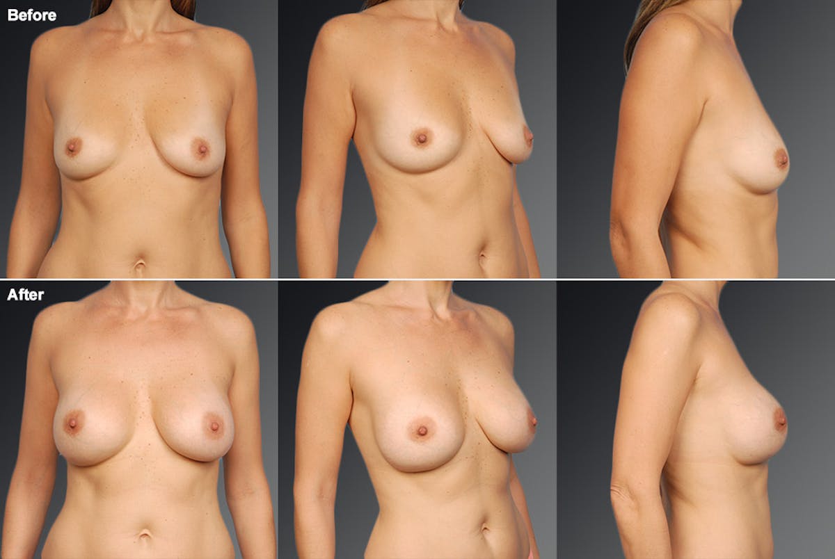 Breast Augmentation Before & After Gallery - Patient 104109173 - Image 1