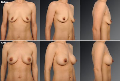 Breast Augmentation Before & After Gallery - Patient 104109174 - Image 1