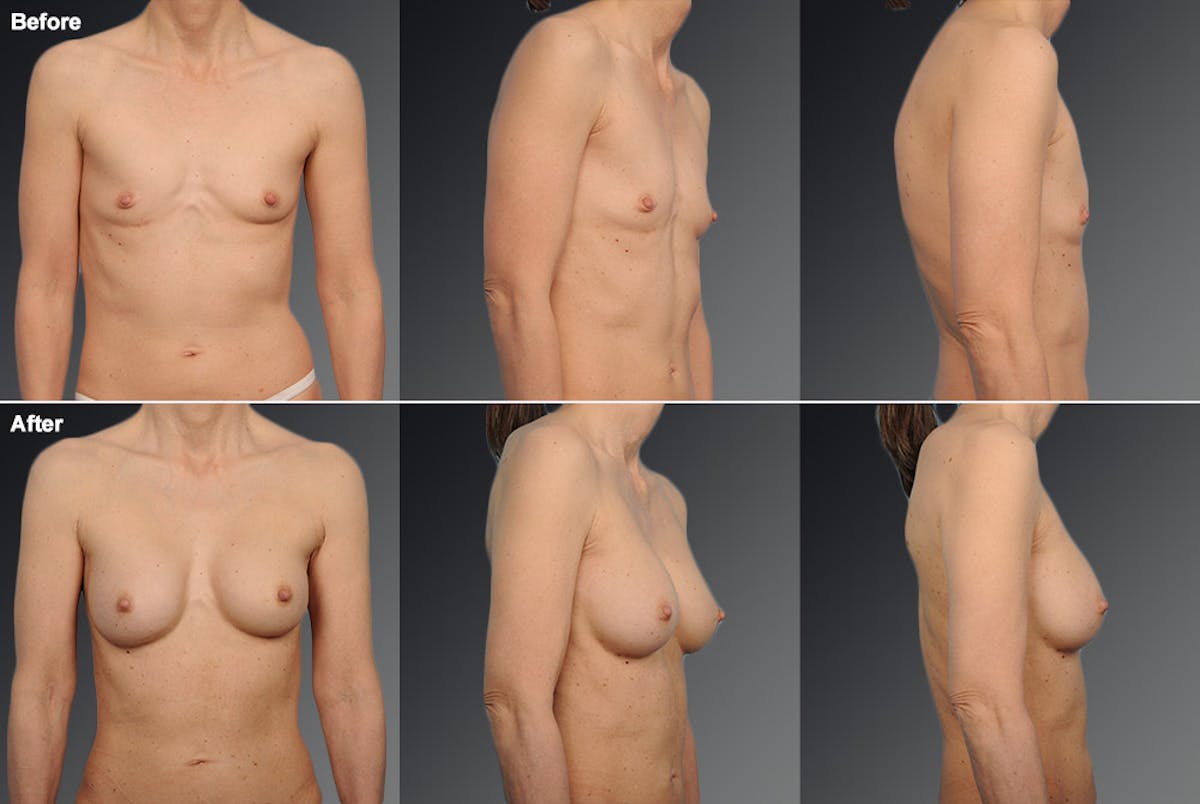 Breast Augmentation Before & After Gallery - Patient 104109176 - Image 1