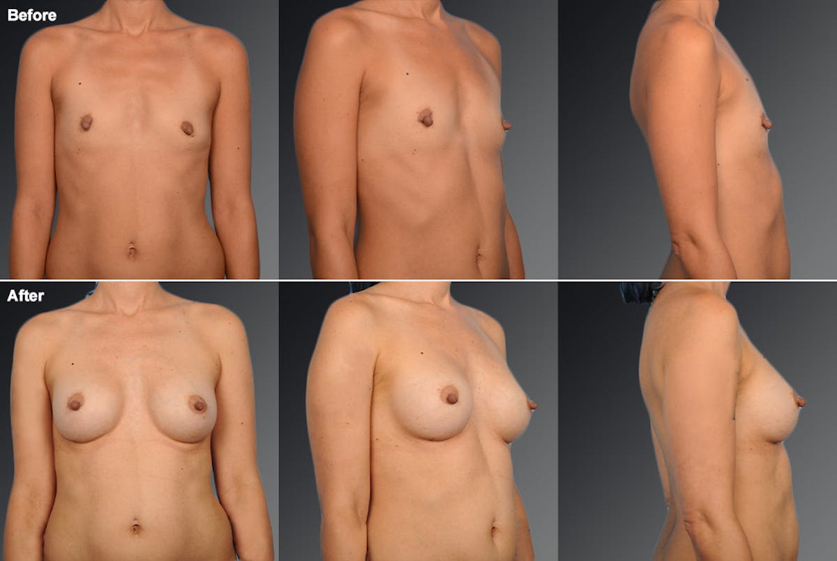 Breast Augmentation Before & After Gallery - Patient 104109178 - Image 1