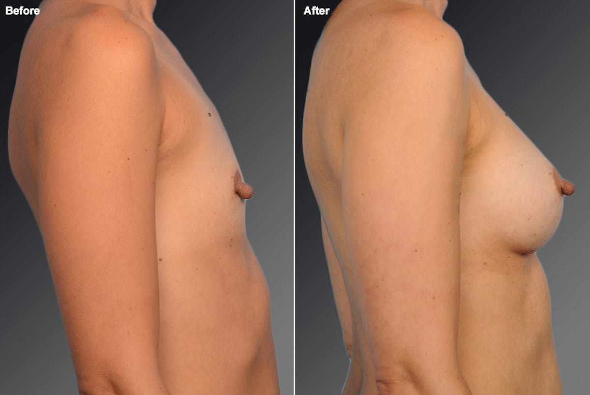 Breast Augmentation Before & After Gallery - Patient 104109183 - Image 1