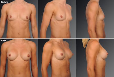 Breast Augmentation Before & After Gallery - Patient 104109184 - Image 1