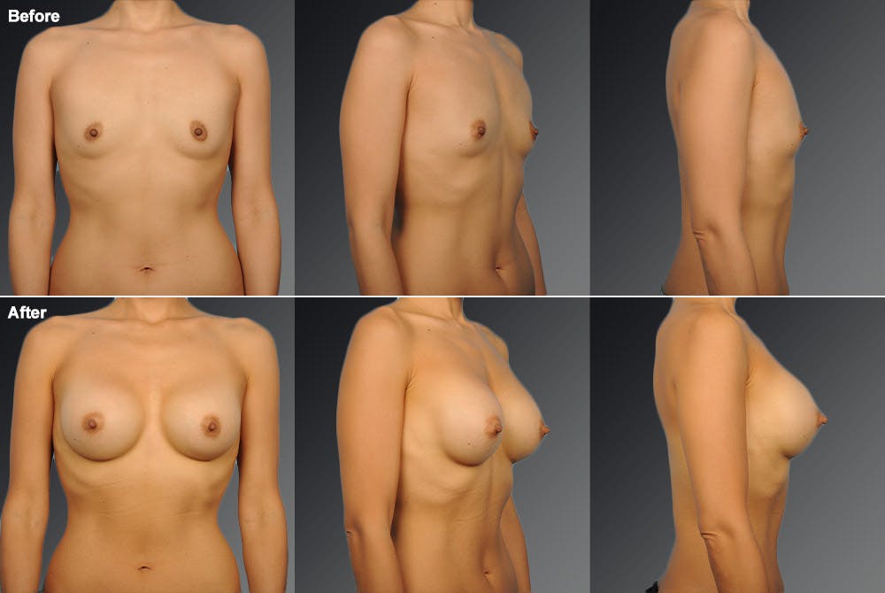 Breast Augmentation Before & After Gallery - Patient 104109191 - Image 1